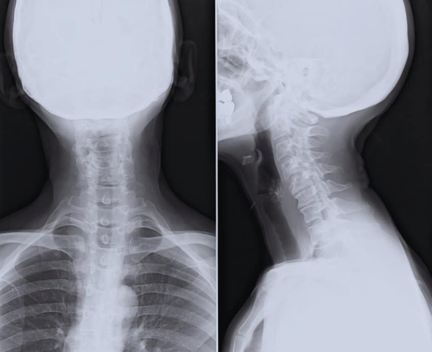 Cervical spine X-ray vertebral subluxation Stewart Chiropractic Hendersonville TN